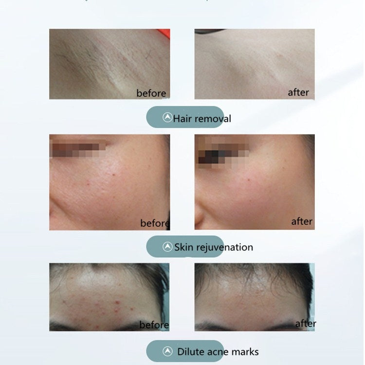 IPL Hair Remover - BeautyLand